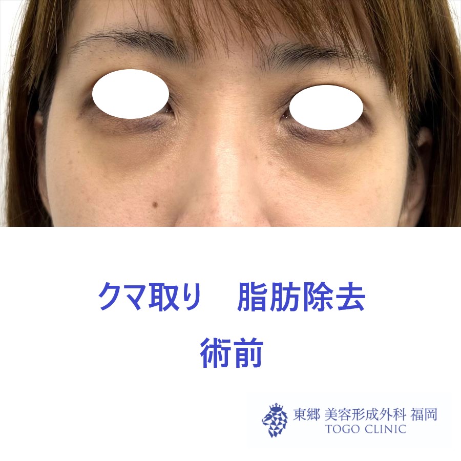 MN　経結膜脱脂術前