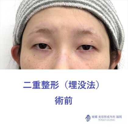 MS　二重埋没術前 (1)