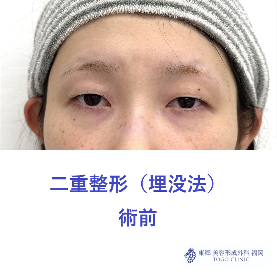 MS　二重埋没術前 (1)