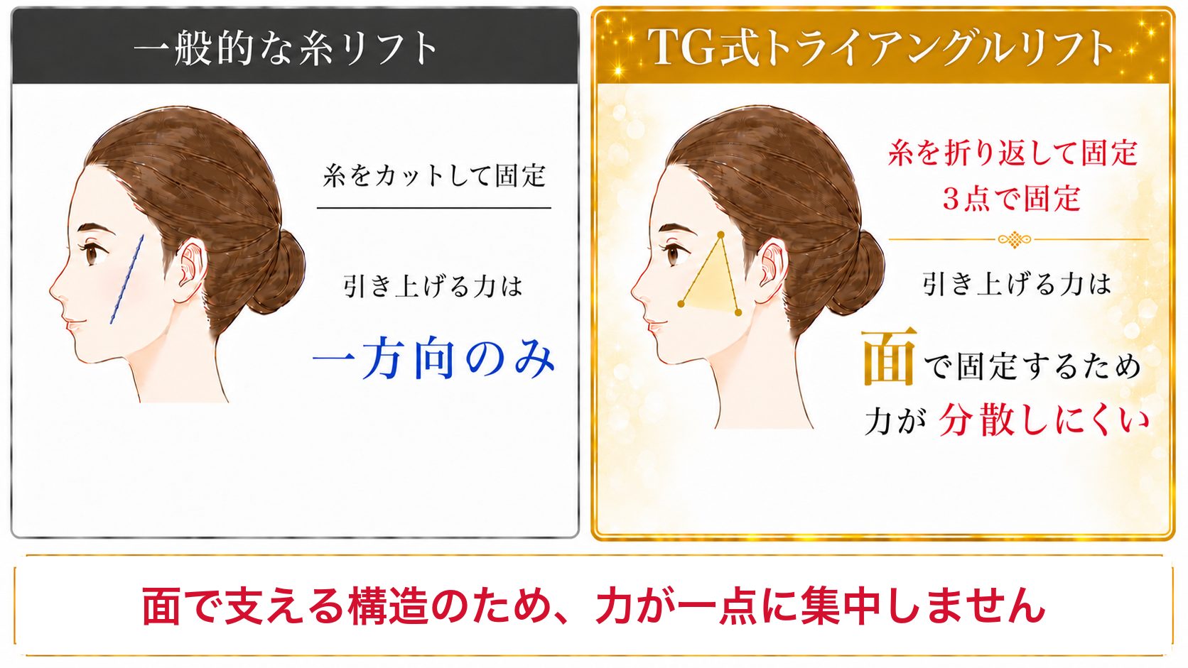 当院オリジナルの糸リフト