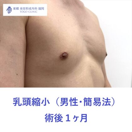 HK　乳頭縮小術後１ヶ月