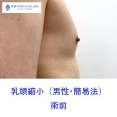 HK 乳頭縮小術前 (2)