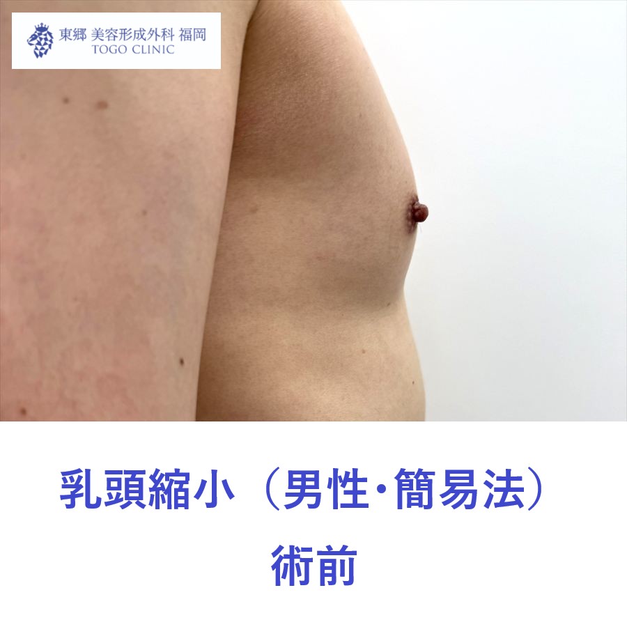 HK　乳頭縮小術前 (2)