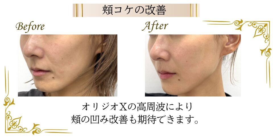 オリジオによる高周波で、頬の凹みが改善している前後の比較写真