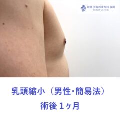 HK 乳頭縮小術後1ヶ月 (2)