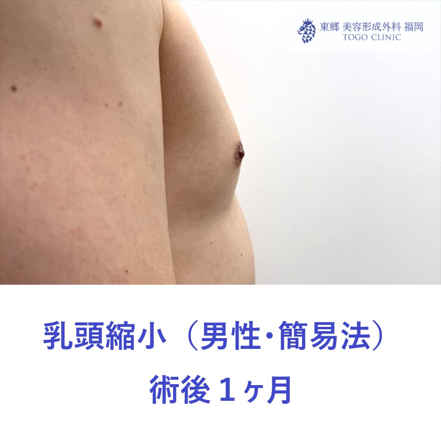 HK　乳頭縮小術後１ヶ月 (2)