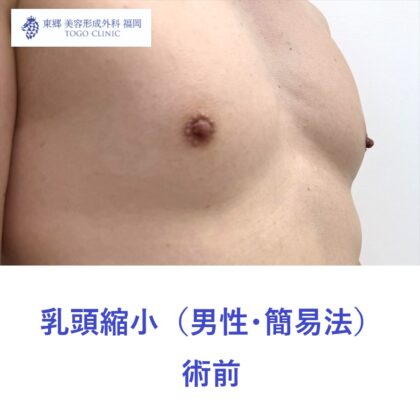 HK　乳頭縮小術前