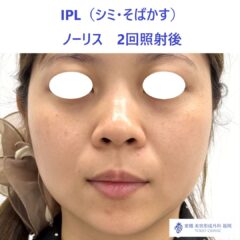 MK ノーリス術後