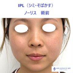 MK ノーリス術前