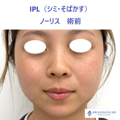 MK　ノーリス術前