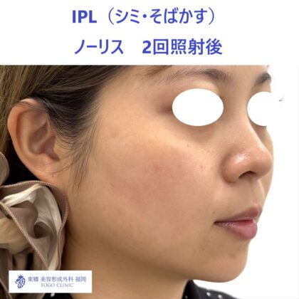 MK　ノーリス術後３