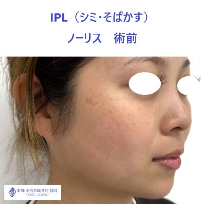 MK　ノーリス術前３