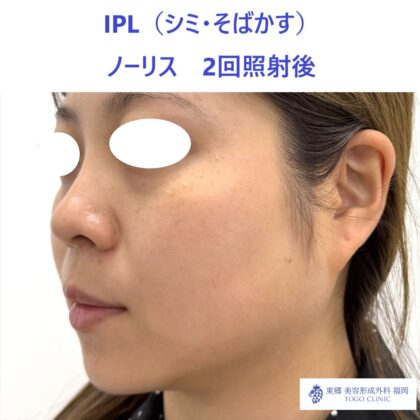 MK　ノーリス術後２