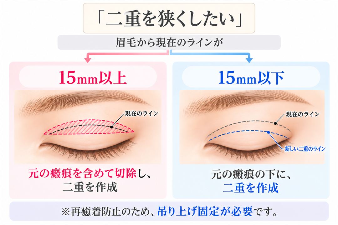 「二重を狭くしたい」眉毛から現在のラインが15mm以上：元の瘢痕を含めて切除し、二重を作成。15mm以下：元の瘢痕の下に、二重を作成。※再癒着防止のため、吊り上げ固定が必要です。
