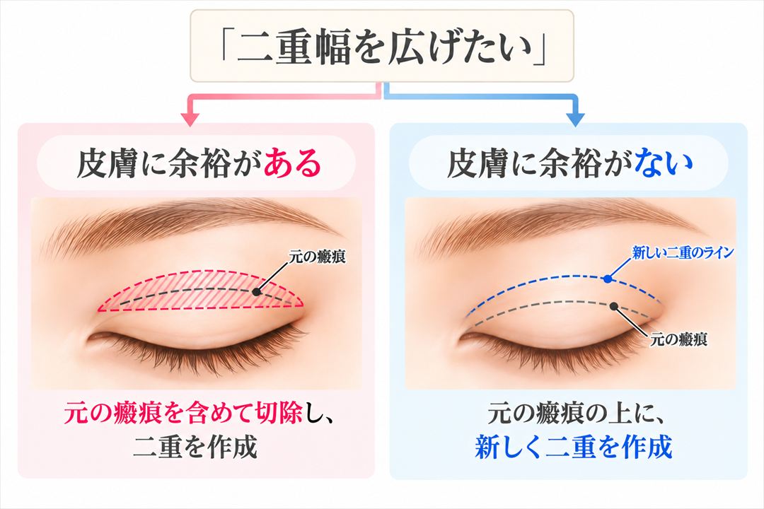 「二重幅を広げたい」場合の術式。皮膚に余裕がある：元の瘢痕を含めて切除し、二重を作成。皮膚に余裕がない：元の瘢痕の上に、新しく二重を作成。