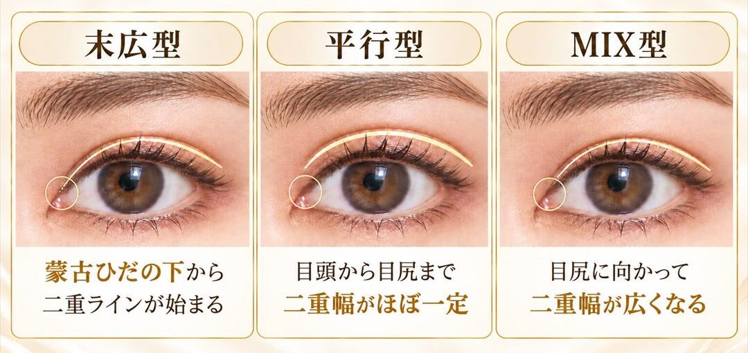 二重の形の違いとは? 末広型:蒙古ひだの下から二重ラインが始まる。平行型:目頭から目尻まで二重幅がほぼ一定。MIX型:目尻に向かって二重幅が広くなる。