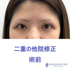KH　他院二重修正術前