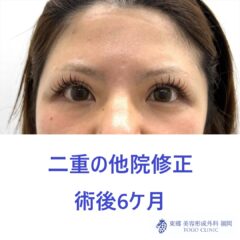KH　他院二重修正 術後