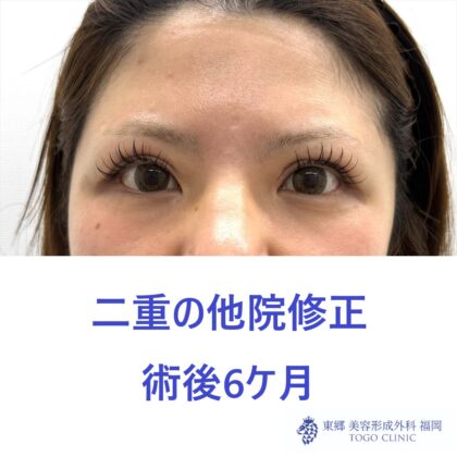KH　他院二重修正 術後