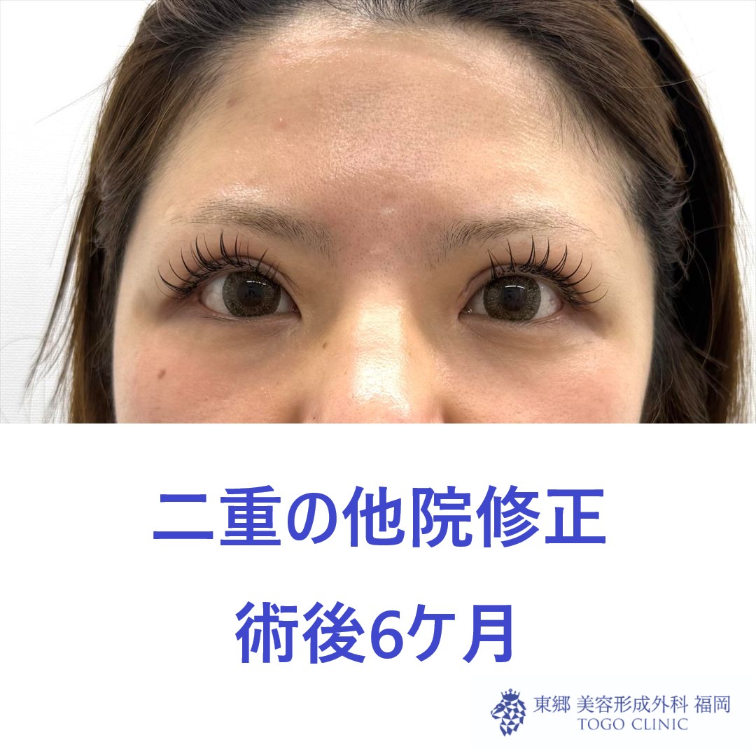 KH　他院二重修正 術後